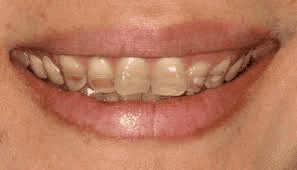 Przebarwienia zębów - wybielanie zębów Brzesko Bochnia